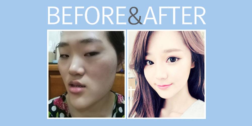 صورة ١٥ صورة صادمة لكوريين قبل وبعد عمليات التجميل