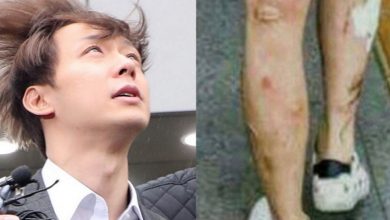 صورة [الآراء] صور يوتشون القديمة لجروحه الشديدة على ساقيه ويديه عادت للسطح مجددا بعد اعترافه بتعاطي للمخدرات