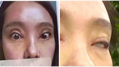 صورة امرأة صينية أصبحت غير قادرة أبدا على إغلاق عينيها بعد عمليتي جفن مزدوج فاشلتين